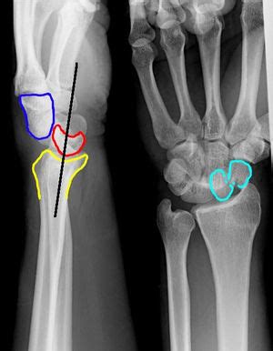 Perilunate and lunate dislocations - WikEM