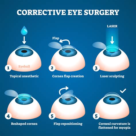 Chirurgie Laser Des Yeux Technique Du Lasik à Uccle