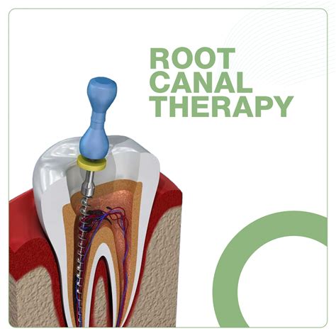 Root Canal Therapy Specialty Care Procare Dental Group