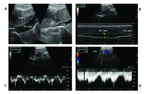 A Longitudinal Scan Of The Inferior Vena Cava Including The Veno Atrial