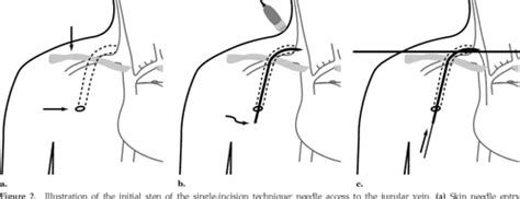 Chest port placement with use of the single-incision insertion ...