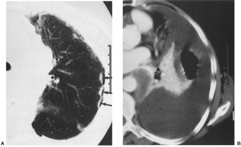 Disease Of The Pleura Radiology Key