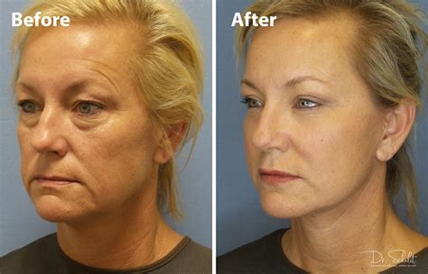 Face And Neck Lift 8 Dr Schalit Cosmetic Facial Specialist