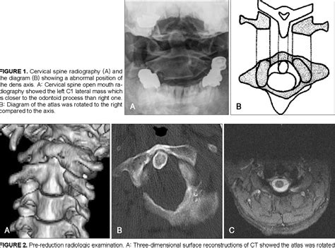 Figure From The Atlanto Axial Rotatory Fixation In Adult Treated By