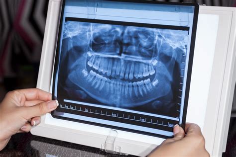 3 Types Of Dental X Ray