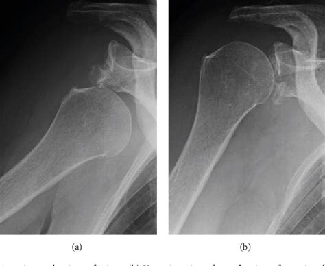 Figure 1 From Concurrent Rotator Cuff Tear And Axillary Nerve Palsy Associated With Anterior