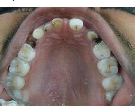 Figure From Non Syndromic Oligodontia With Multiple Retained