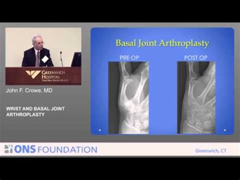 Thumb Basilar Joint Arthroplasty With Lrti