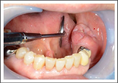 Figure 2 From Endoscopically Assisted Marginal Mandibulectomy Using An