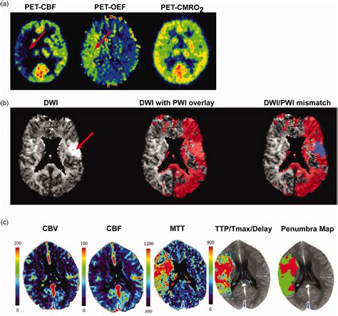 The Ischemic Penumbra From Concept To Reality Charlotte M Ermine