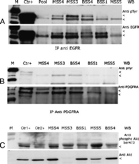 Egfr Pdgfr And Akt Expression And Activation In Pediatric Ss A