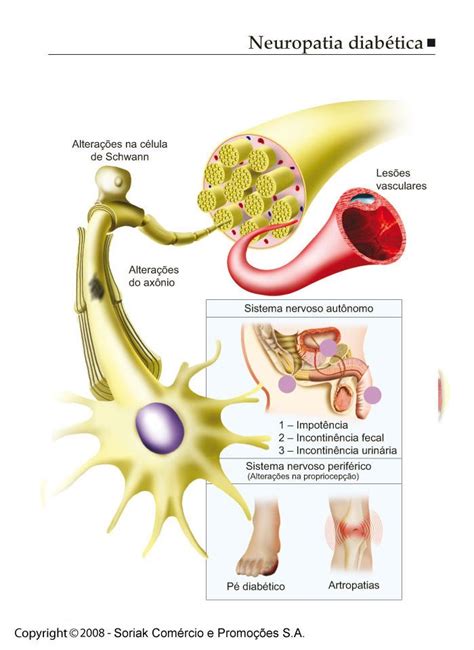 Pró Clinica DF O que é Neuropatia Diabética