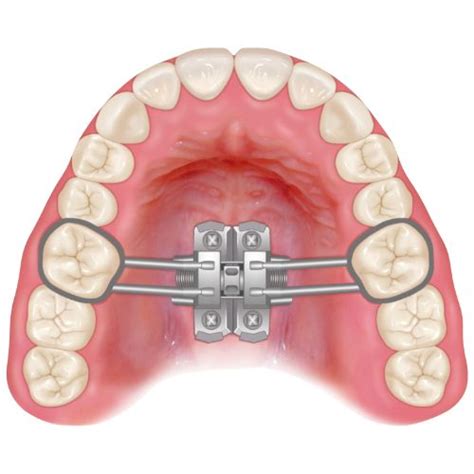 MARPE A expansão maxilar ancorada em mini implantes Instituto