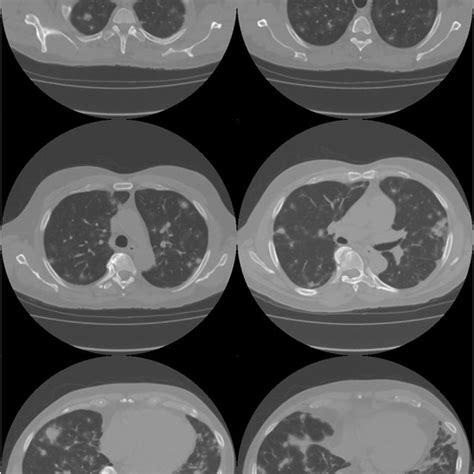 Chest X Ray Showing Bilateral Nodular Opacities In The Lungs