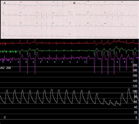 Deleterious Effects Of Isolated Right Ventricular Pacing In Right