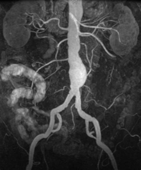 Aorta Abdominalis Doccheck Flexikon