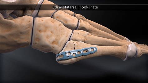 5th Metatarsal Fracture — Dr Wael Bayoud