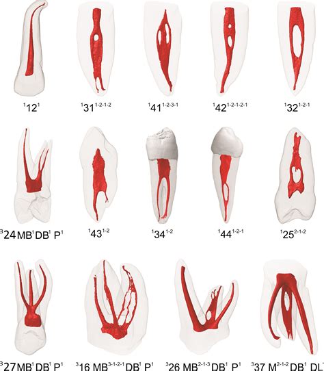 Pdf Root Canal Morphology Of Permanent Maxillary And Mandibular My | Hot Sex Picture