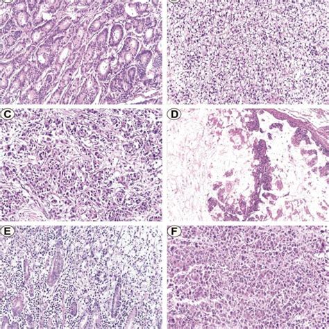 Gastric Adenocarcinoma He Staining X200 A Tubular Adenocarcinoma Download Scientific