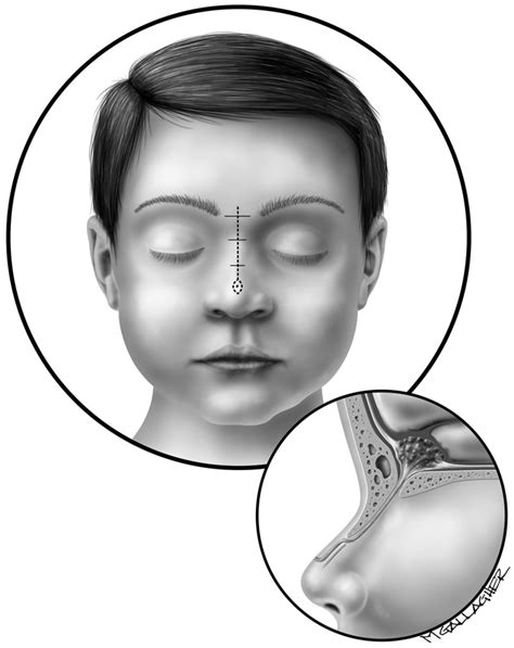 Dermoid Cyst Bridge Of Nose