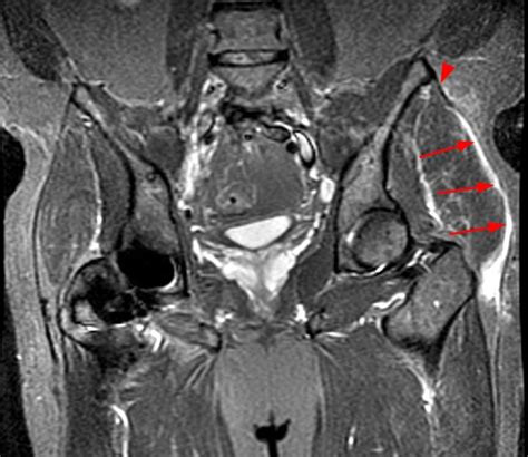 proximal iliotibial band syndrome radsource