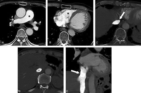 Ct Pulmonary Angiography Ctpa Images From A 68 Year Old Man Group A