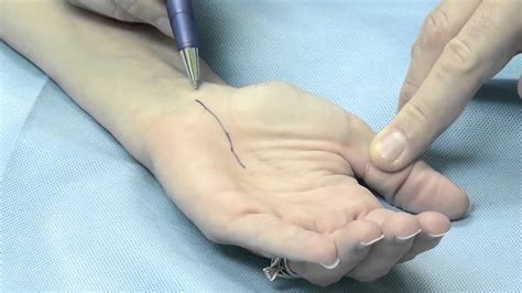 Endoscopic Carpal Tunnel Procedure Youtube