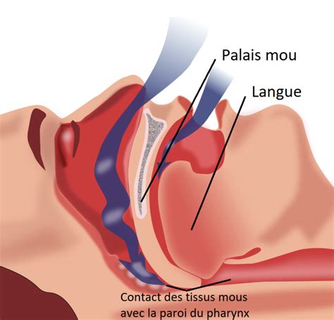 Le Syndrome d Apnées du Sommeil Dr DEPOORTERE