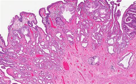 Pathology Outlines Heterotopic Gastric Mucosa