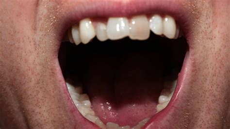 Footballers Have Worryingly Poor Teeth Bbc News