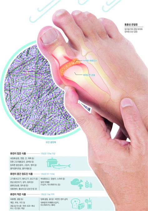 통풍성 관절염 요산 결정체가 원인 매일신문
