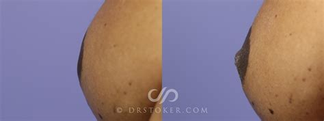 Nipple Inversion Correction Before And After Pictures Case Los