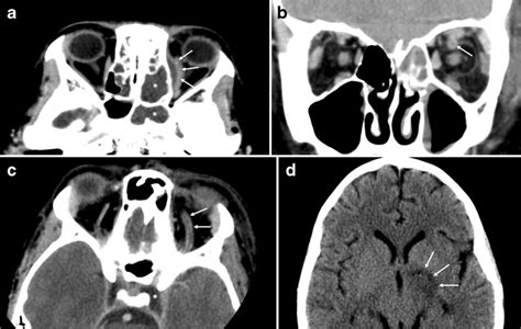 Orbital Subperiosteal Abscess With Cavernous Sinus Thrombosis In A Download Scientific Diagram