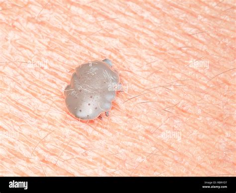 Scabies Mite On Skin