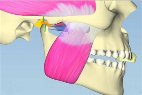 Digital Anterior Bite Plane - Spear Education