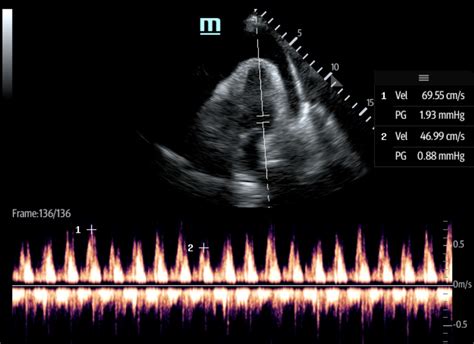 Pericardial Effusion VPeak Max 69 VPeak Min 46 Ultrasound JETem 2017 - JETem