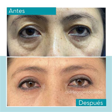 Blefaroplastia en Bogotá Dr Leonardo Rueda