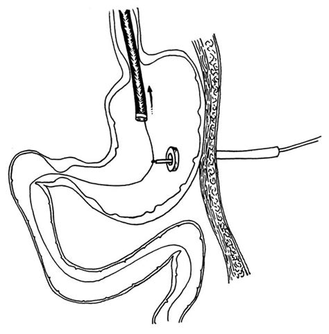 Percutaneous Endoscopic Gastrostomy Jejunostomy PEG PEJ Tube