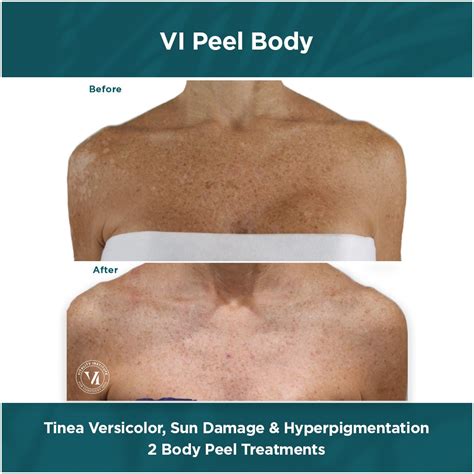 Chemical Peel For Body Tres Belle Petite Medi Spa