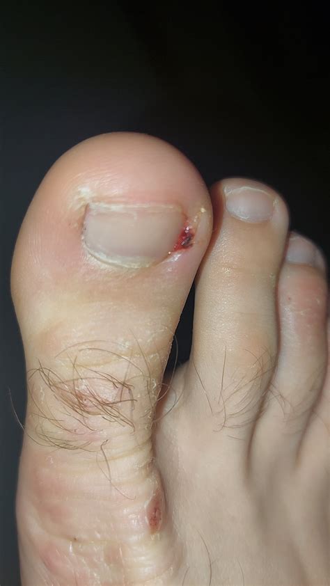 Is this normal one year after phenol matrixectomy? : r/Ingrown_Toenails