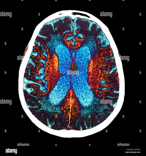 Alzheimers Disease Ct Scan Stock Photo Alamy