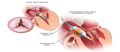 Heart Valve Surgery Treatment in Delhi | Heart Valve Replacement ...