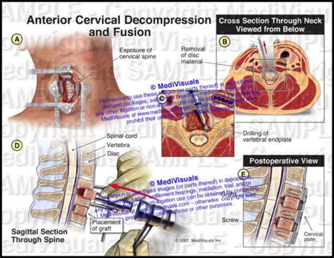 Anterior Cervical Decompression And Fusion Acdf Medivisuals Inc