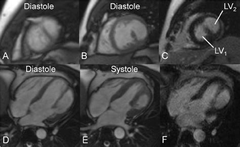 Cardiac Magnetic Resonance Imaging Mri With The Cine A B D And