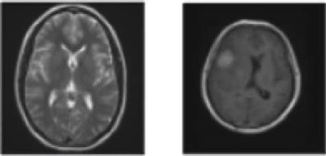 No-brain tumor image and brain image with tumor | Download Scientific ...