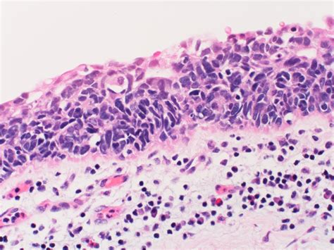 Small Cell Lung Cancer - GED Preparation