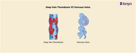 Deep Vein Thrombosis Vs Varicose Veins Know The Differences Knya