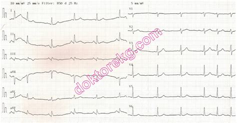 Akut Inferiyor Miyokard Infarktüsü Acute Inferior Myocardial Infarction Ekg Ecg Ankara