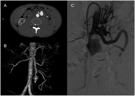 Images Of An Inflammatory Aneurysm Of The Superior Mesenteric Artery