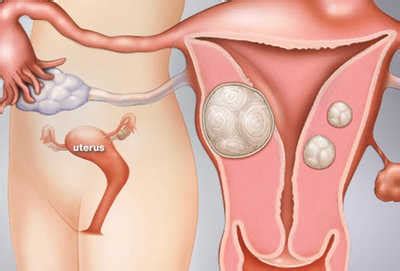 How Fibroids Are Measured